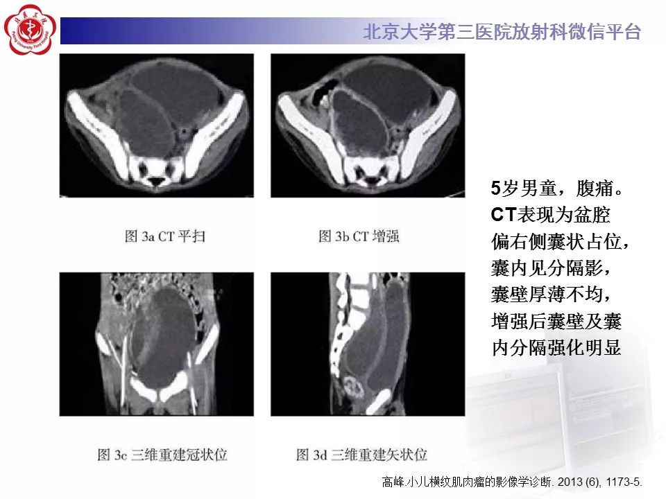 【病例】脊柱胚胎性横纹肌肉瘤1例CT及MR影像表现