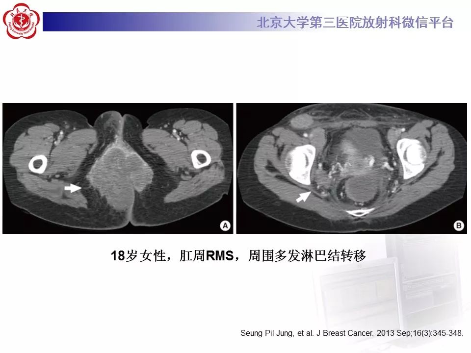 【病例】脊柱胚胎性横纹肌肉瘤1例CT及MR影像表现
