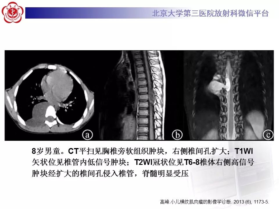 【病例】脊柱胚胎性横纹肌肉瘤1例CT及MR影像表现