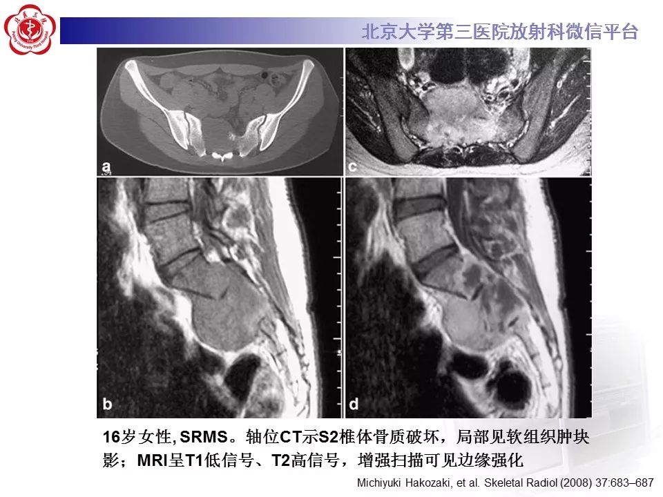 【病例】脊柱胚胎性横纹肌肉瘤1例CT及MR影像表现