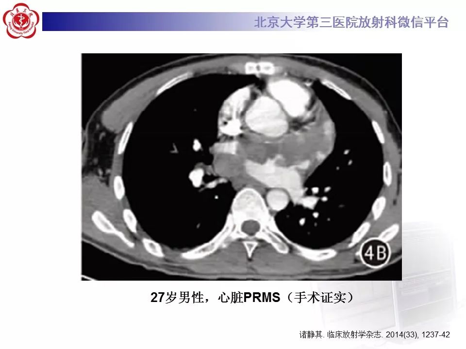 【病例】脊柱胚胎性横纹肌肉瘤1例CT及MR影像表现