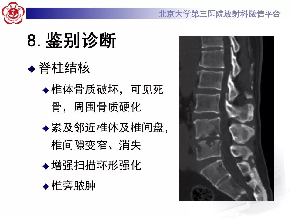 【病例】脊柱胚胎性横纹肌肉瘤1例CT及MR影像表现