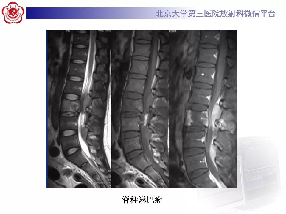 【病例】脊柱胚胎性横纹肌肉瘤1例CT及MR影像表现