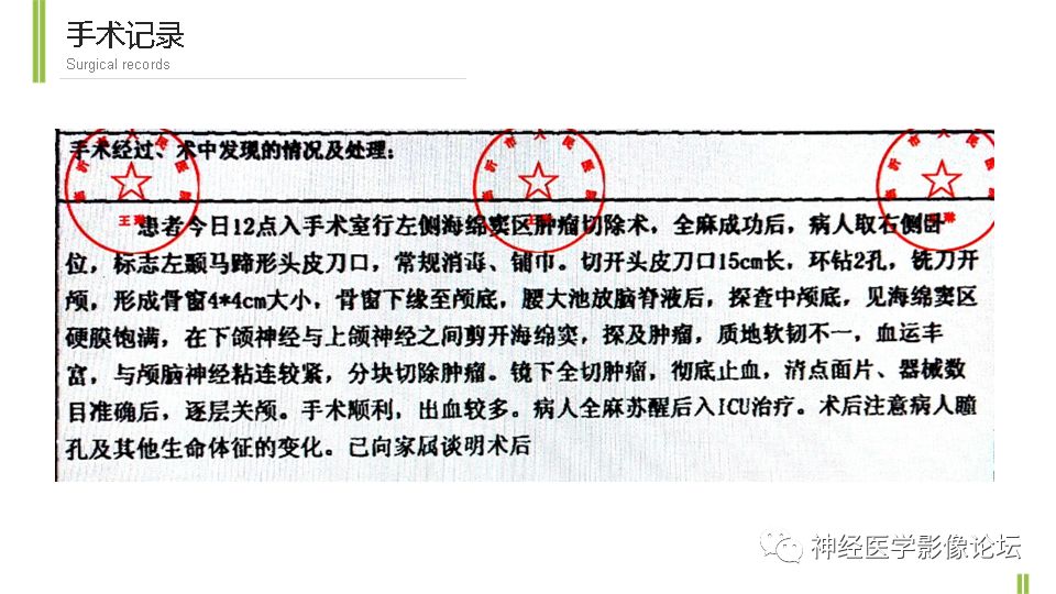 【病例】鞍旁孤立性纤维瘤/血管外皮细胞瘤1例CT及MR