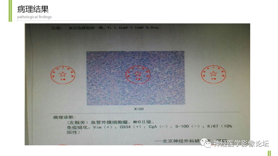 【病例】鞍旁孤立性纤维瘤/血管外皮细胞瘤1例CT及MR