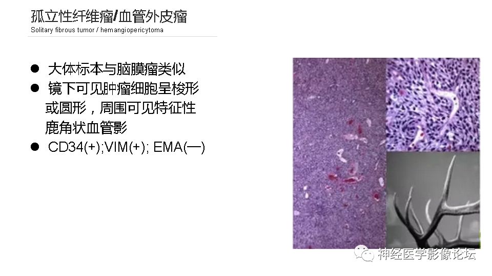 【病例】鞍旁孤立性纤维瘤/血管外皮细胞瘤1例CT及MR