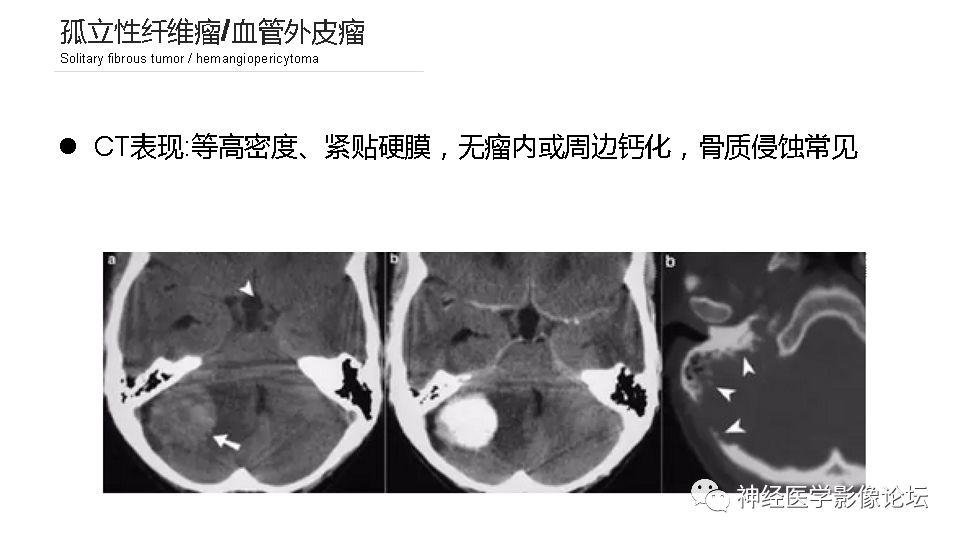 【病例】鞍旁孤立性纤维瘤/血管外皮细胞瘤1例CT及MR