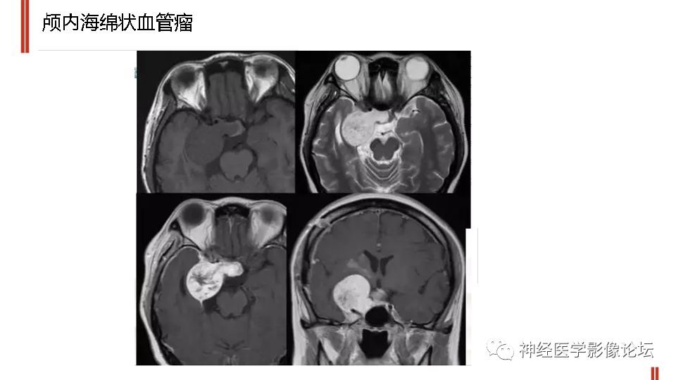 【病例】鞍旁孤立性纤维瘤/血管外皮细胞瘤1例CT及MR