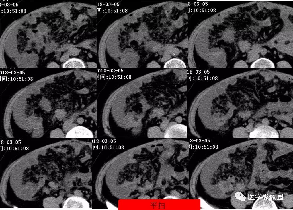 【病例】阑尾恶性肿瘤1例CT