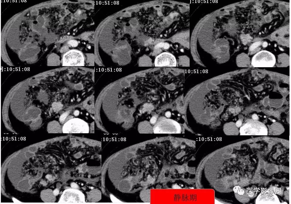【病例】阑尾恶性肿瘤1例CT