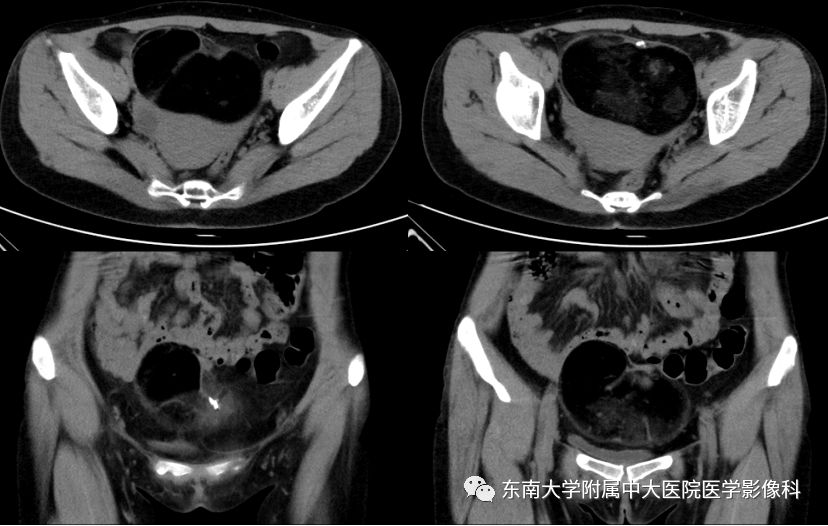 【病例】卵巢畸胎瘤VS囊腺瘤