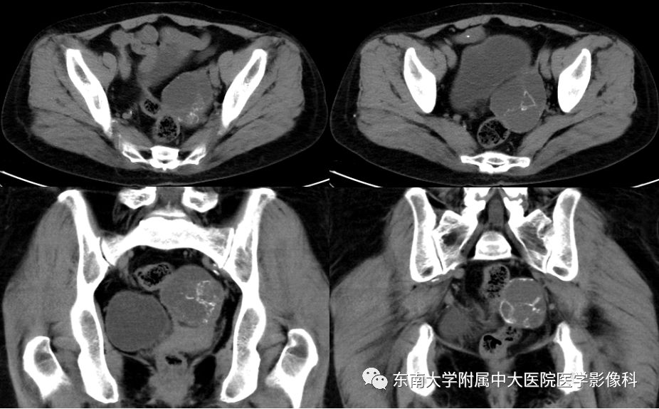 【病例】卵巢畸胎瘤VS囊腺瘤
