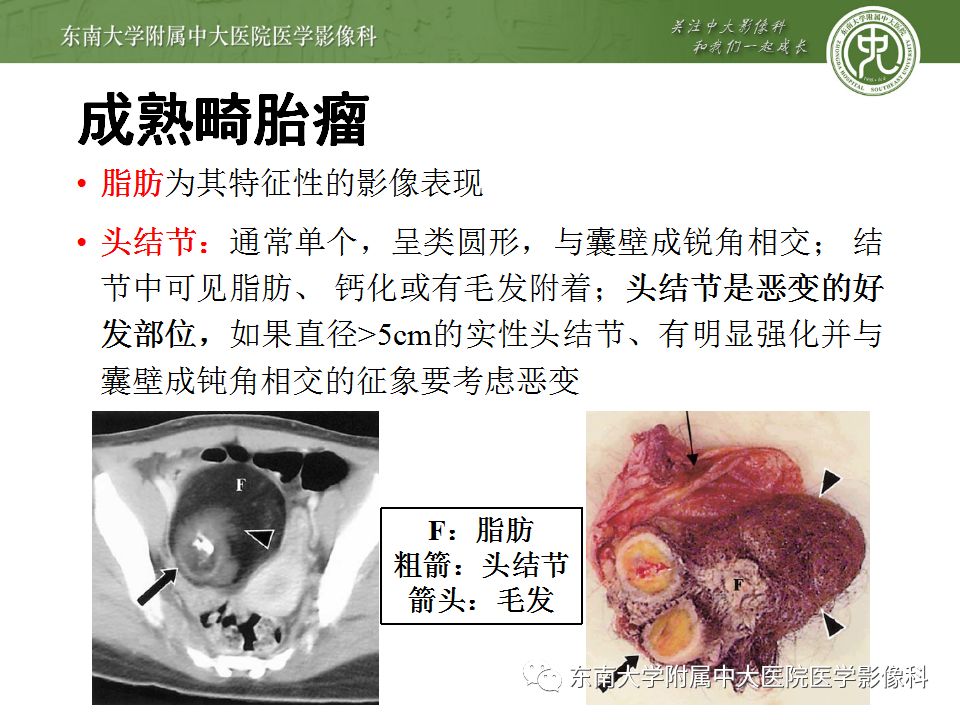 【病例】卵巢畸胎瘤VS囊腺瘤