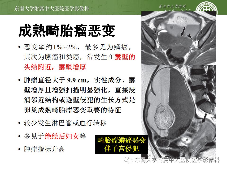 【病例】卵巢畸胎瘤VS囊腺瘤