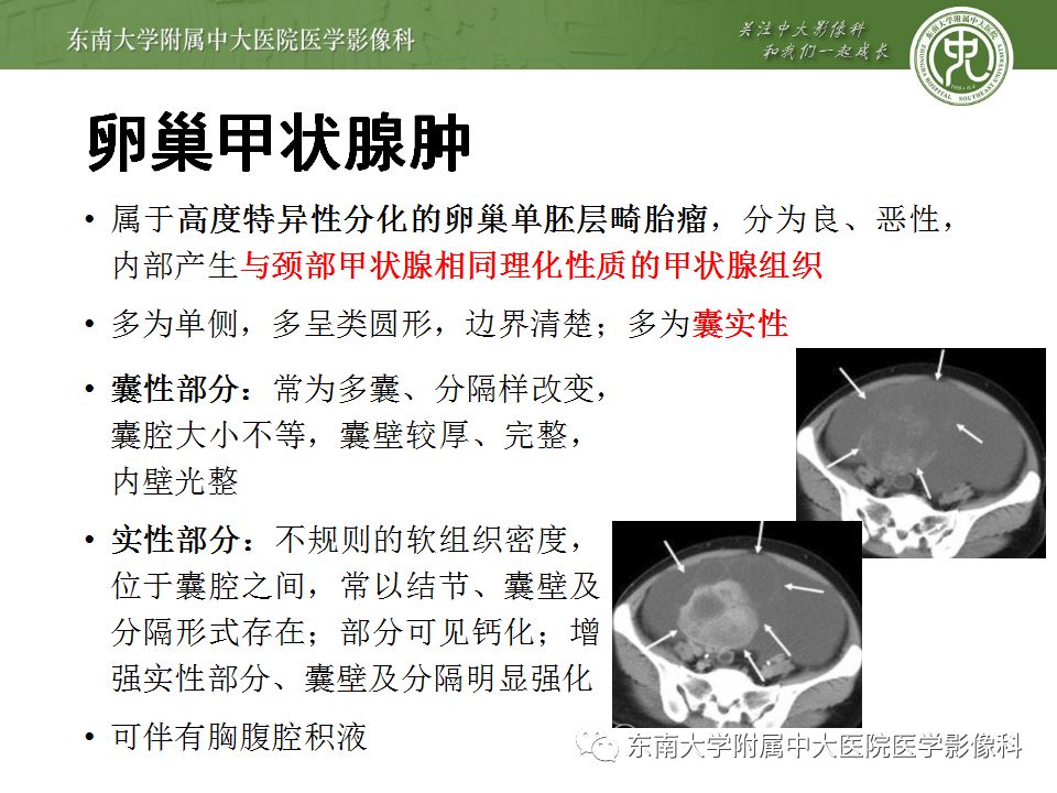 【病例】卵巢畸胎瘤VS囊腺瘤