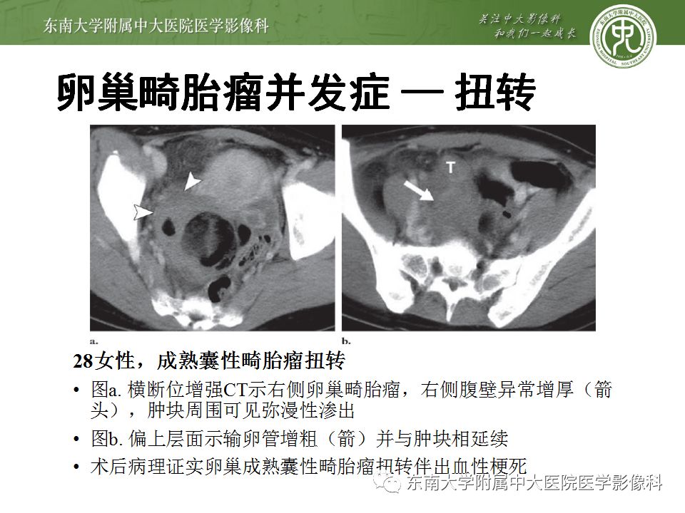 【病例】卵巢畸胎瘤VS囊腺瘤