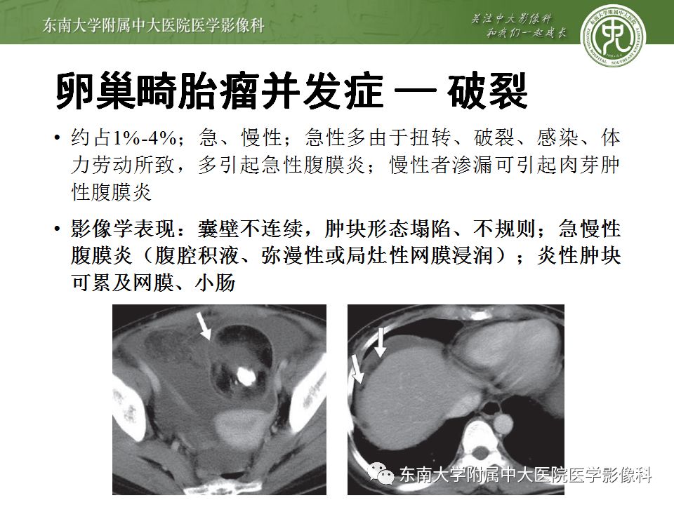 【病例】卵巢畸胎瘤VS囊腺瘤