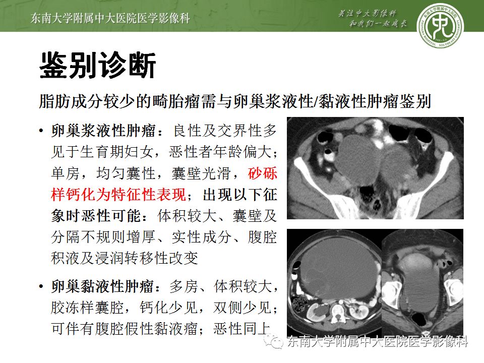 【病例】卵巢畸胎瘤VS囊腺瘤