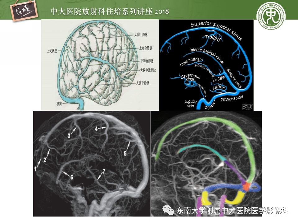 【PPT】脑静脉血栓影像表现及图像解读误区