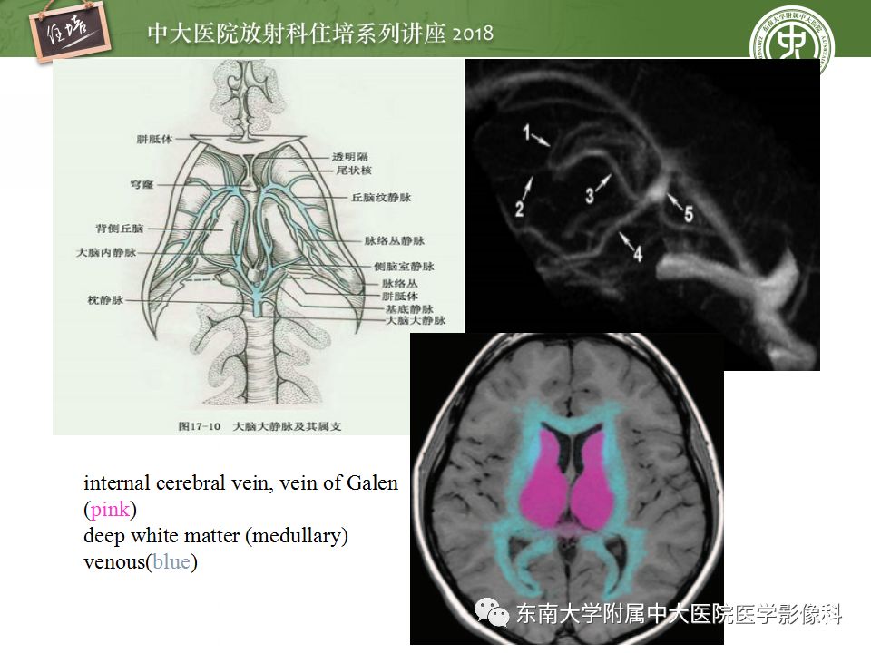 【PPT】脑静脉血栓影像表现及图像解读误区