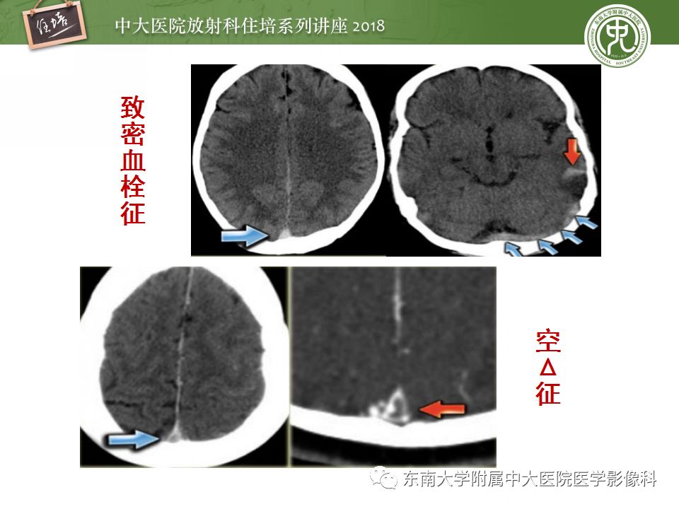 【PPT】脑静脉血栓影像表现及图像解读误区