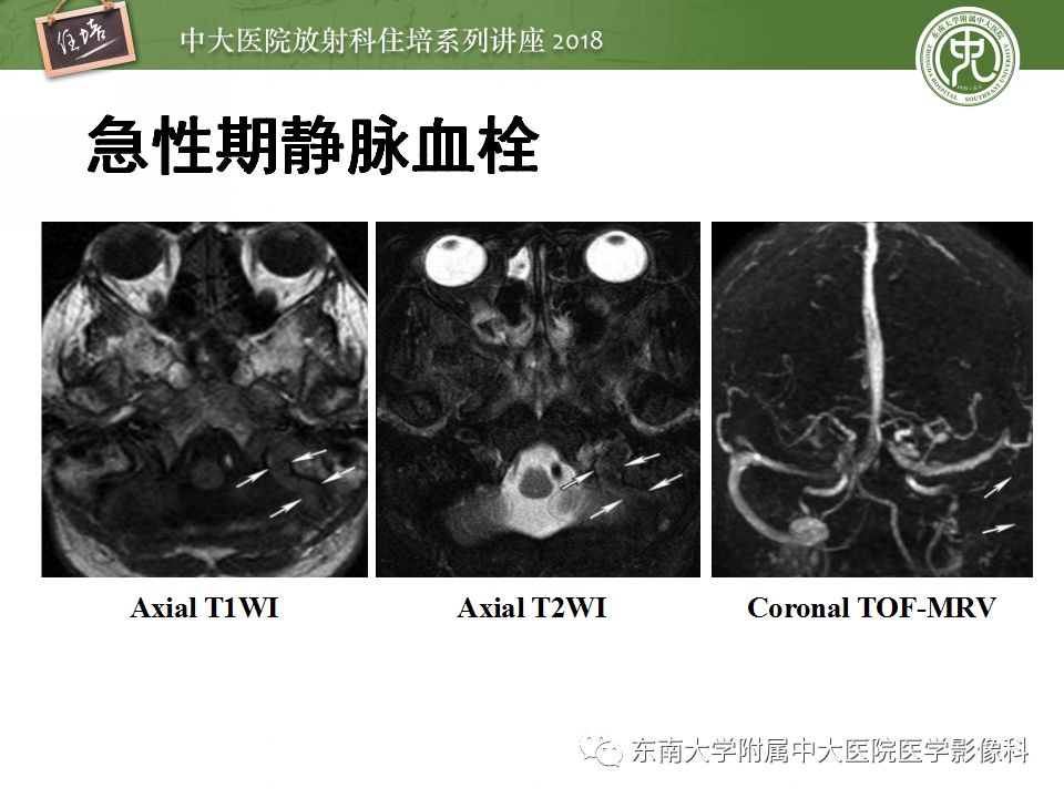 【PPT】脑静脉血栓影像表现及图像解读误区