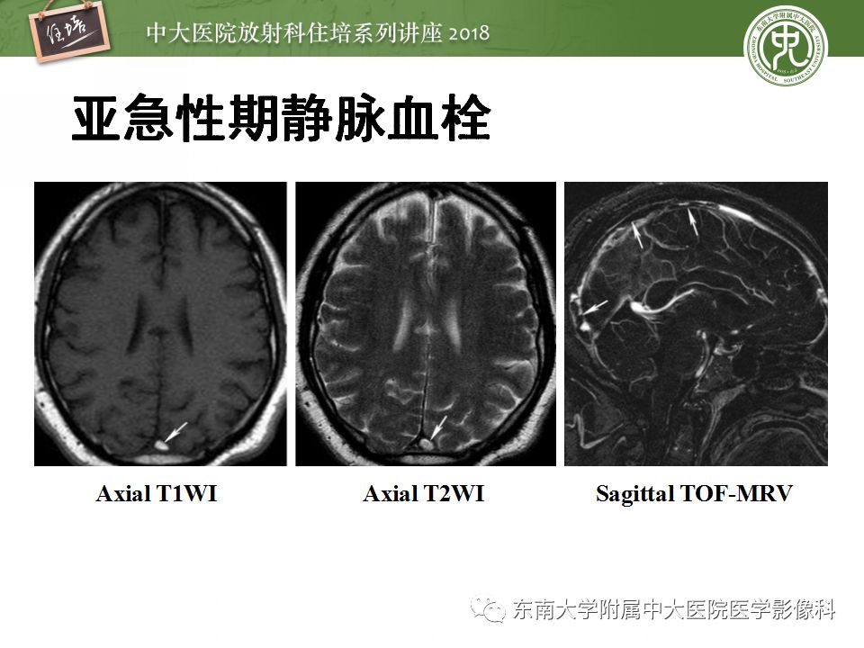 【PPT】脑静脉血栓影像表现及图像解读误区