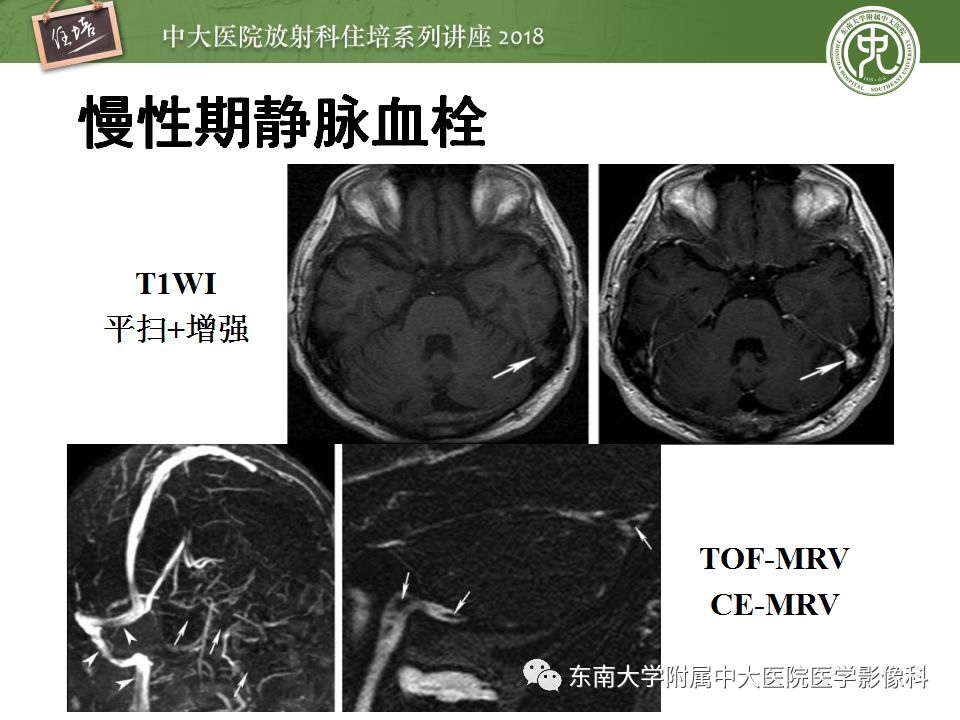 【PPT】脑静脉血栓影像表现及图像解读误区