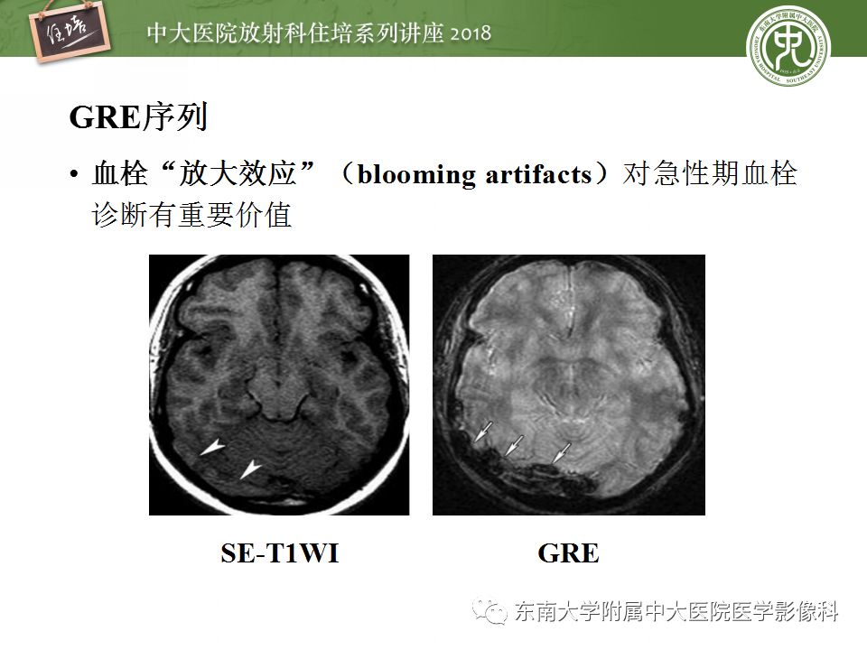 【PPT】脑静脉血栓影像表现及图像解读误区