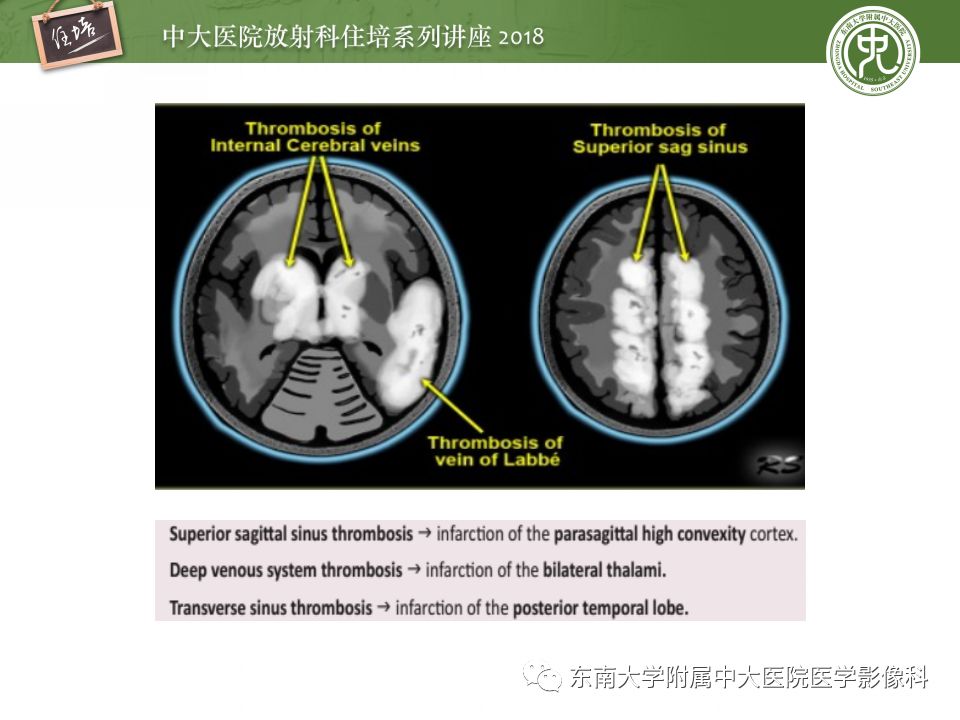 【PPT】脑静脉血栓影像表现及图像解读误区