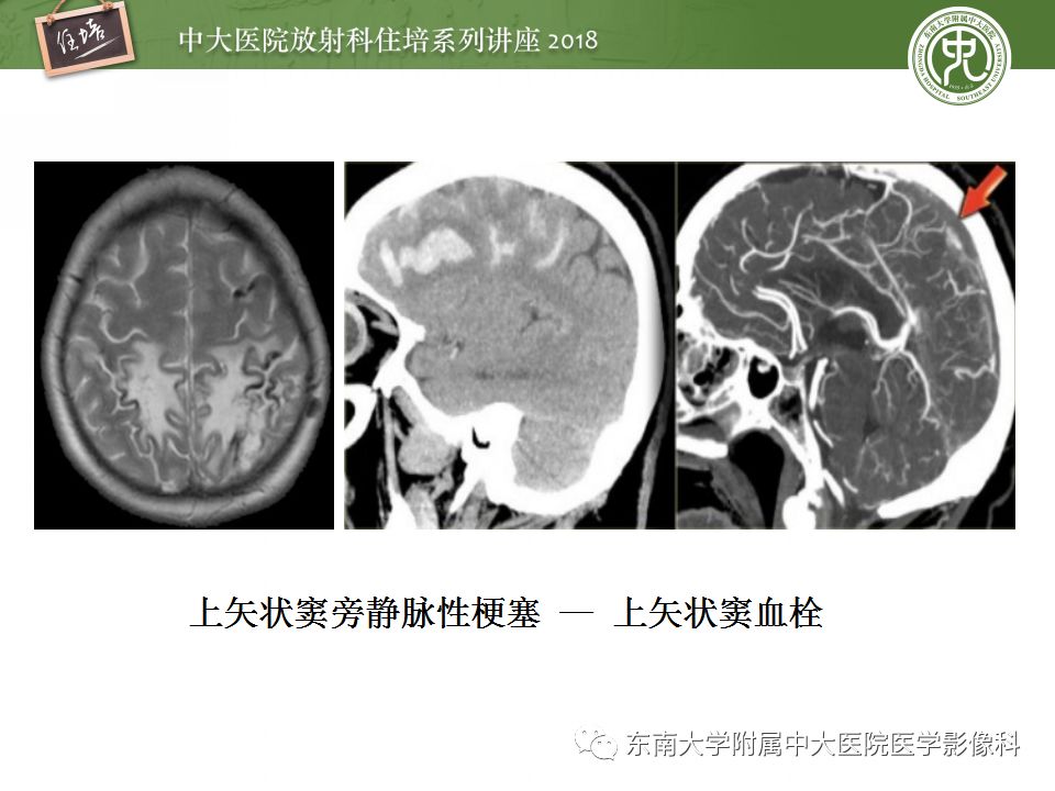 【PPT】脑静脉血栓影像表现及图像解读误区