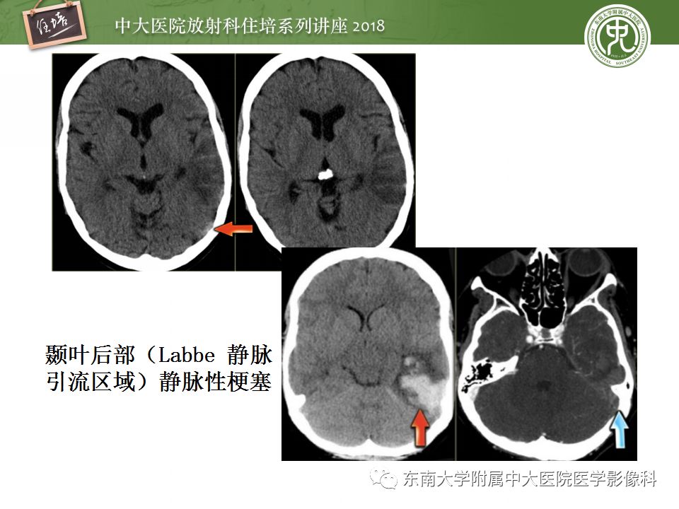 【PPT】脑静脉血栓影像表现及图像解读误区