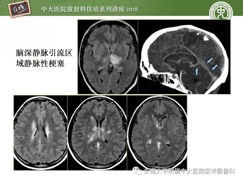 【PPT】脑静脉血栓影像表现及图像解读误区