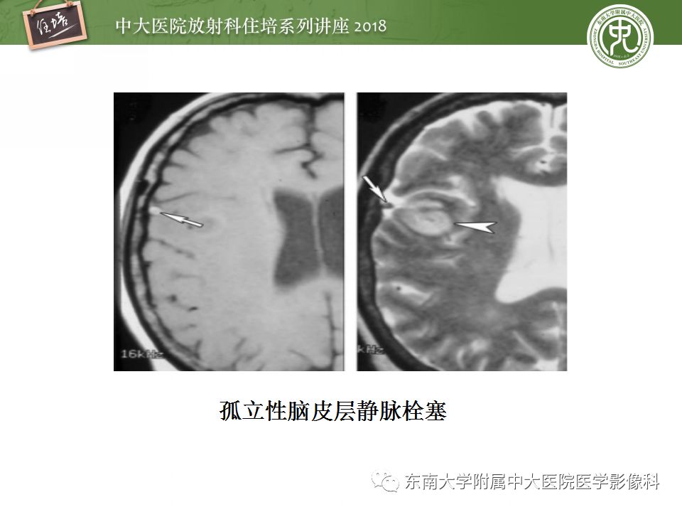 【PPT】脑静脉血栓影像表现及图像解读误区
