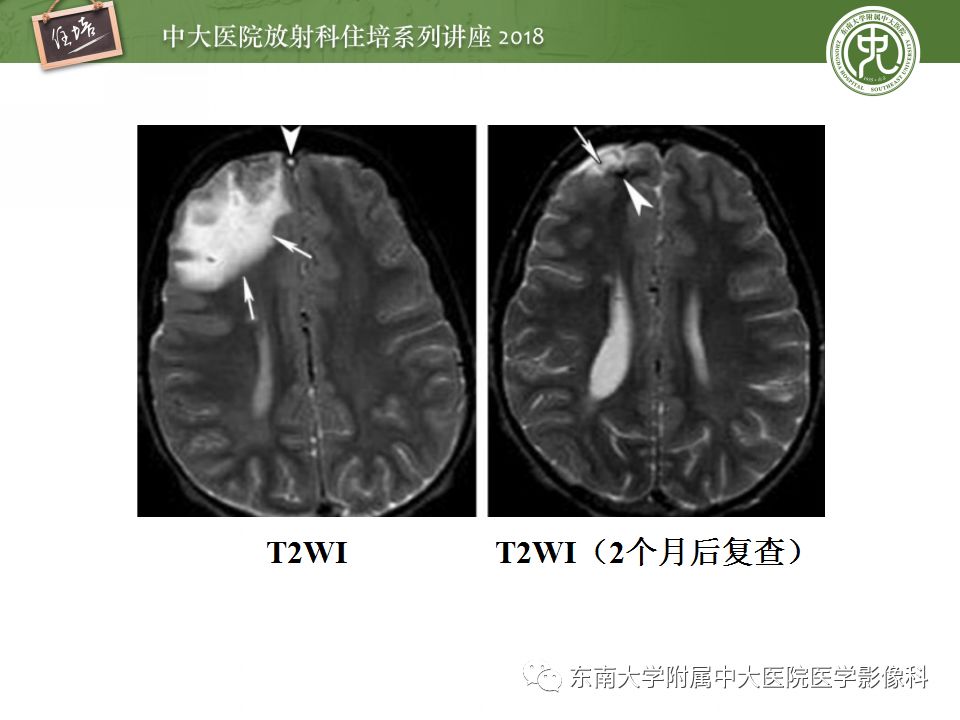 【PPT】脑静脉血栓影像表现及图像解读误区