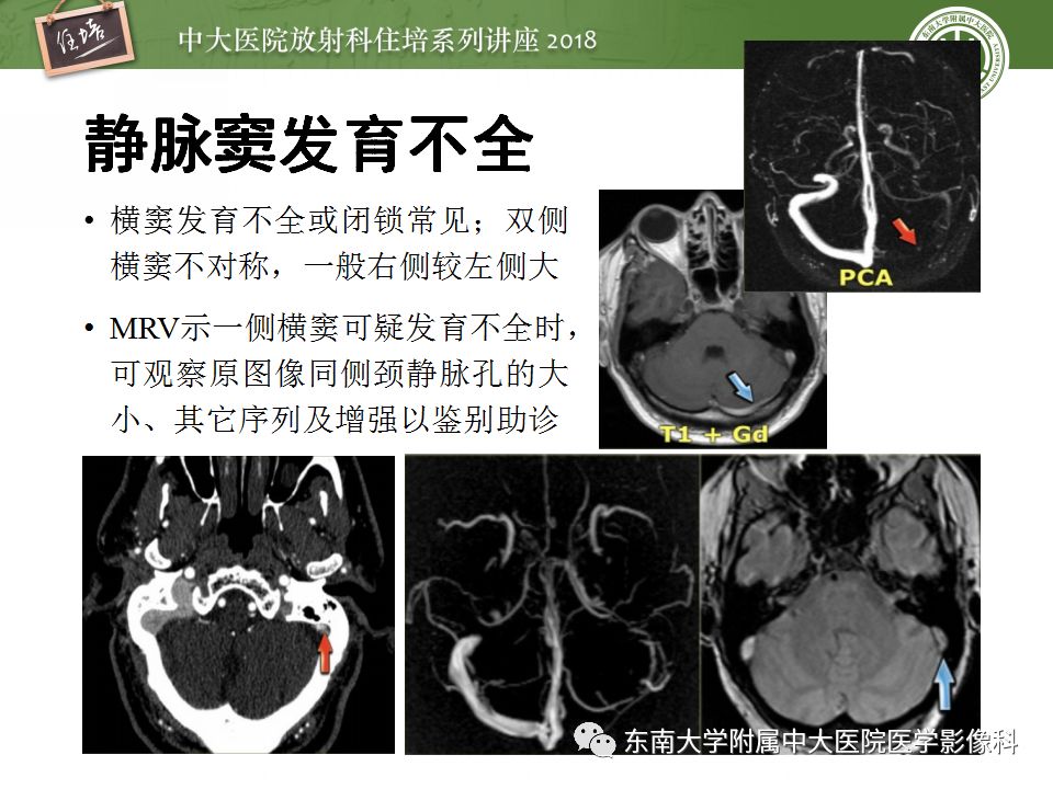 【PPT】脑静脉血栓影像表现及图像解读误区