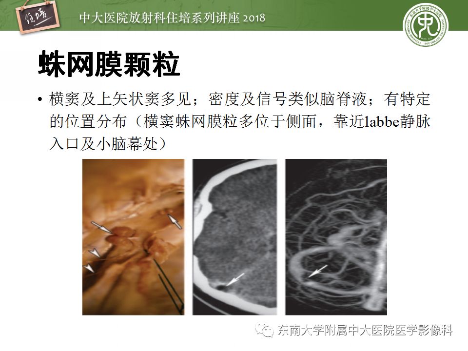 【PPT】脑静脉血栓影像表现及图像解读误区