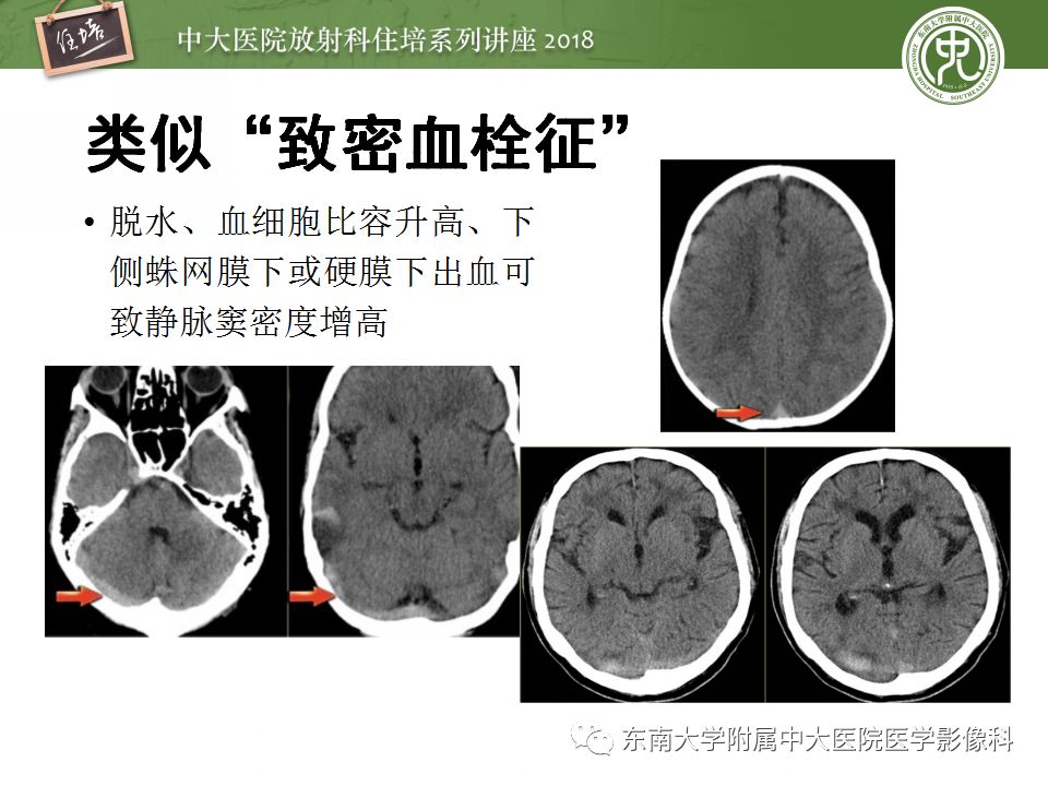 【PPT】脑静脉血栓影像表现及图像解读误区
