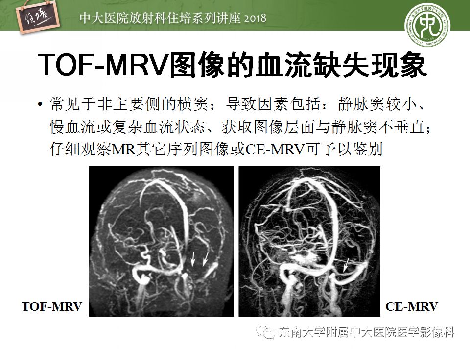 【PPT】脑静脉血栓影像表现及图像解读误区