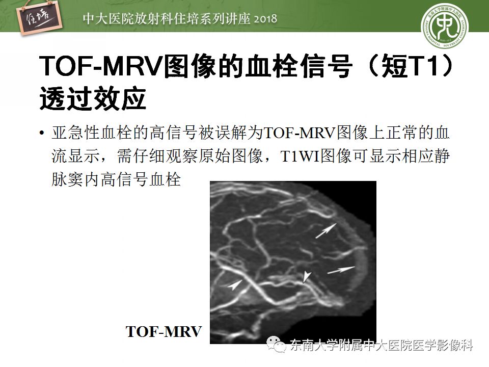 【PPT】脑静脉血栓影像表现及图像解读误区