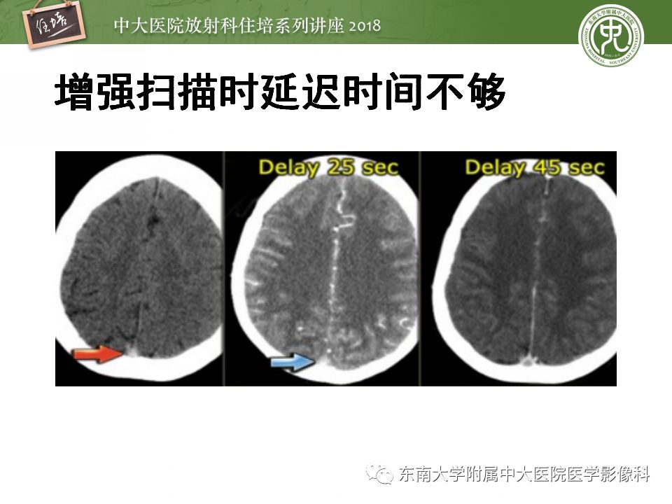 【PPT】脑静脉血栓影像表现及图像解读误区