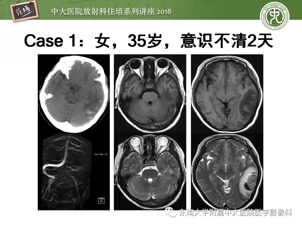 【PPT】脑静脉血栓影像表现及图像解读误区