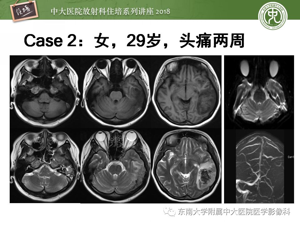 【PPT】脑静脉血栓影像表现及图像解读误区