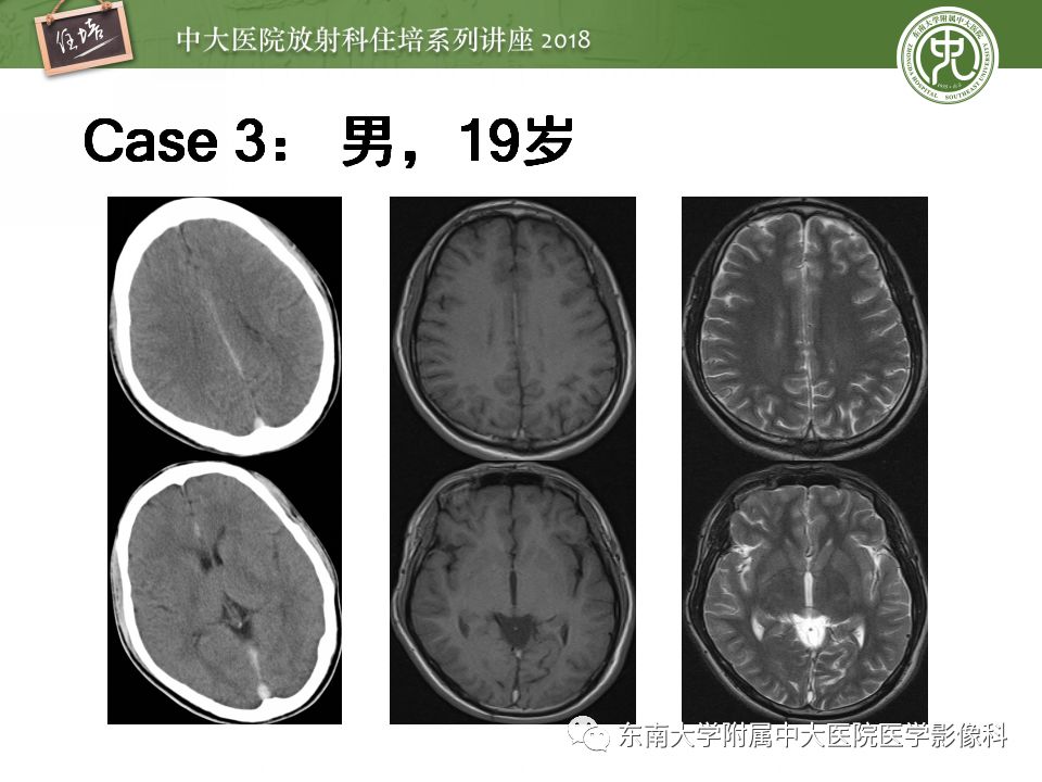 【PPT】脑静脉血栓影像表现及图像解读误区