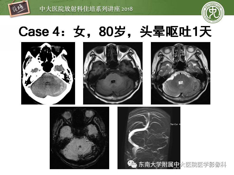 【PPT】脑静脉血栓影像表现及图像解读误区