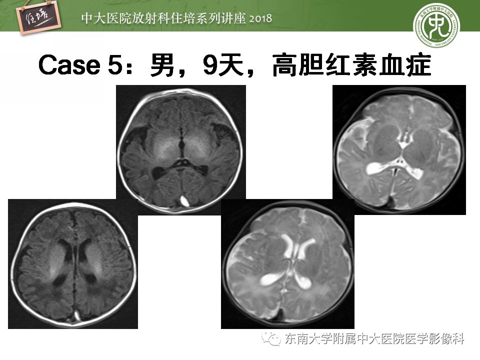 【PPT】脑静脉血栓影像表现及图像解读误区