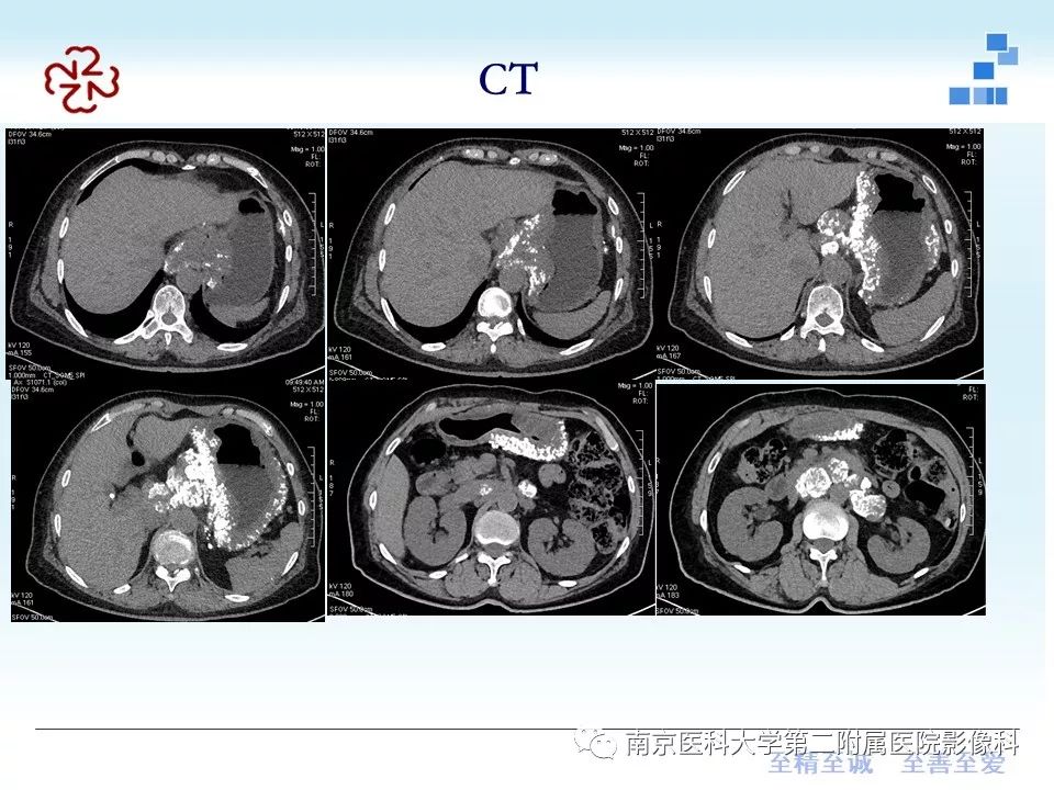 【PPT】胃黏液腺癌的多层螺旋CT表现