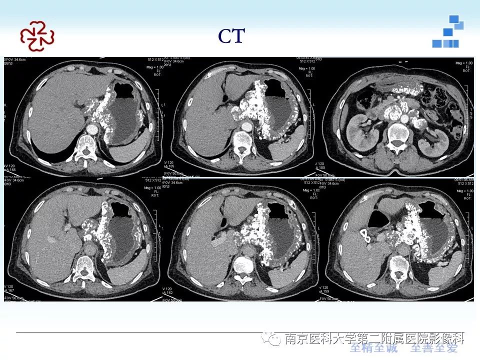 【PPT】胃黏液腺癌的多层螺旋CT表现