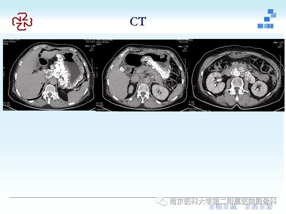 【PPT】胃黏液腺癌的多层螺旋CT表现