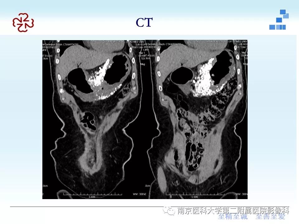 【PPT】胃黏液腺癌的多层螺旋CT表现